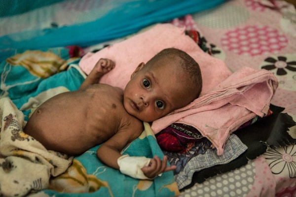bimba neonata malnutrita sul suo lettino colorato in ospedale