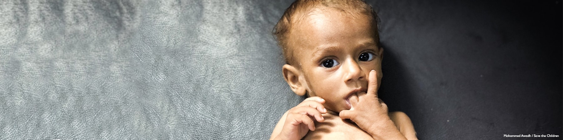 bambino visibilmente malnutrito con la manina in bocca