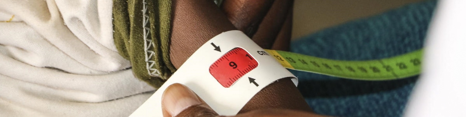 Braccio magro di un bambino etiope con attorno il braccialetto MUAC per misurare la sua grave malnutrizione