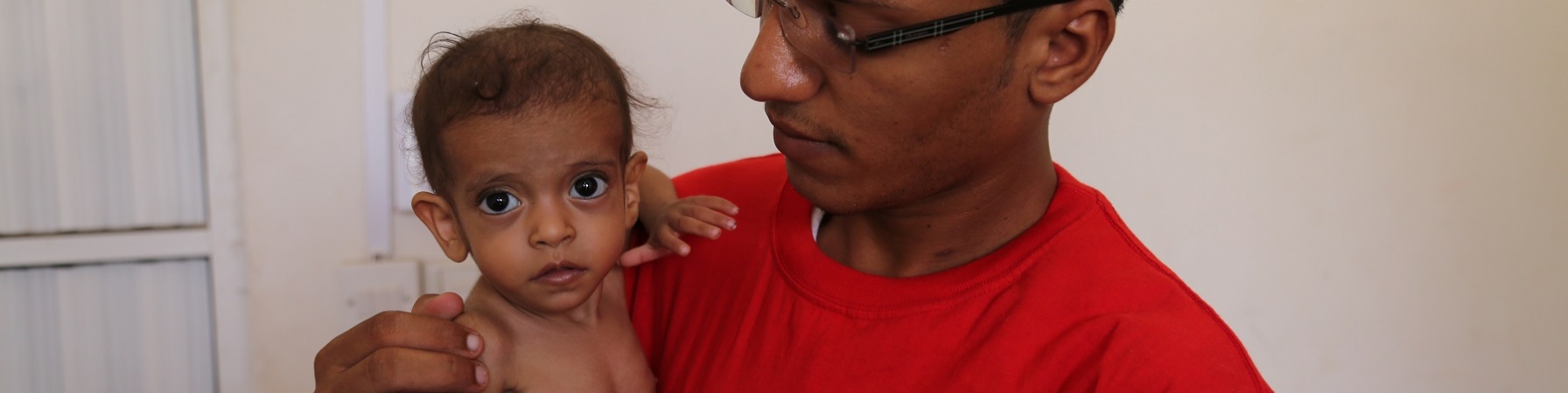 Bambino yemenita malnutrito in braccio a operatore Save the Children