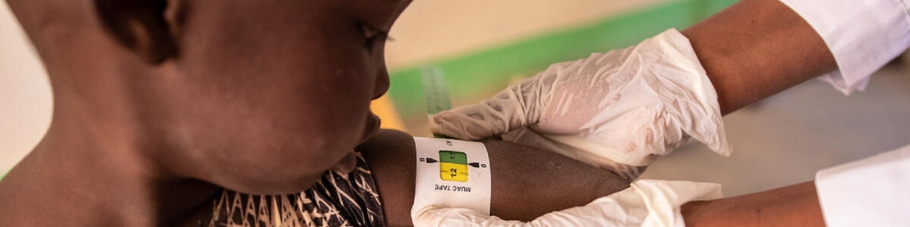 bambino malnutrito e medico che mette attorno al braccio il braccialetto MUAC per misurare il suo stato di malnutrizione