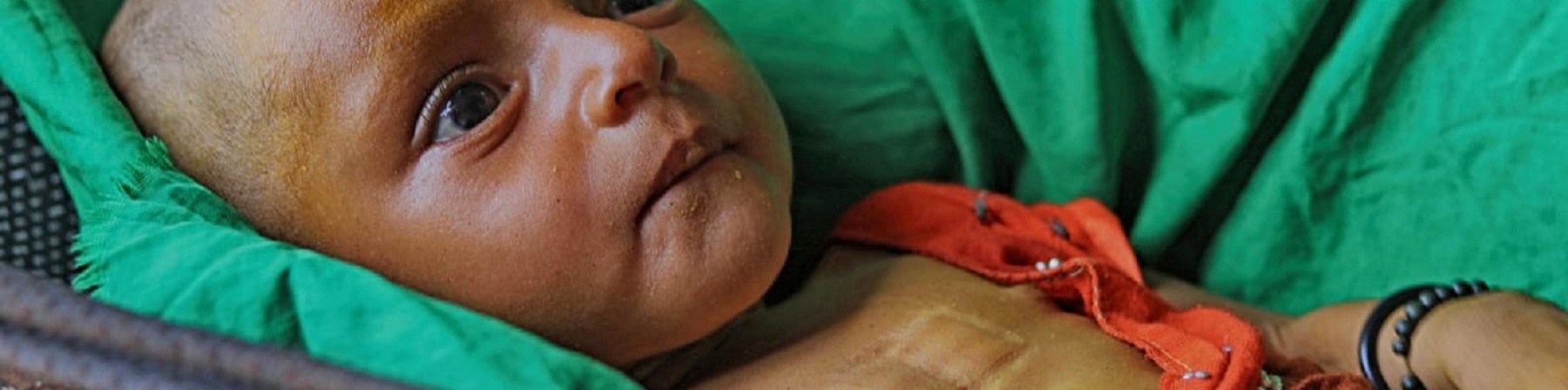 Yemen, dopo 3 anni via alla riapertura dell’aeroporto di Sanaa ai voli sanitari bambina con vestitino rosso sdraiata su lettino con lenzuola verdi