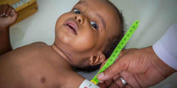 Malnutrizione Yemen