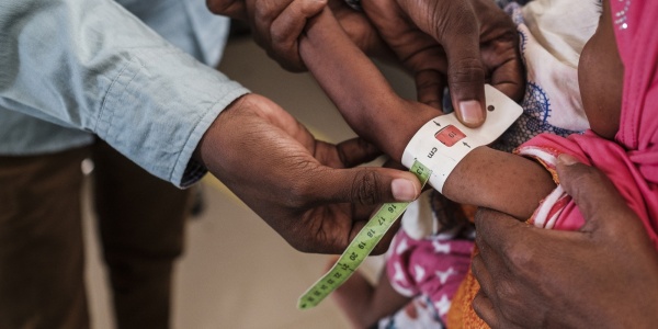 dettaglio sulle mani di un medico che prende la circonferenza del braccio di un bambino malnutrito