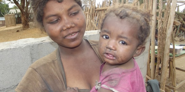 una mamma del Madagascar tiene in bracco sua figlia. La madre indossa una maglietta marrone, la bambina un vestito rosa. La piccola ha u braccio appoggiato al petto della madre e guarda in camera grata verso l obiettivo, la madre guarda la bambina.