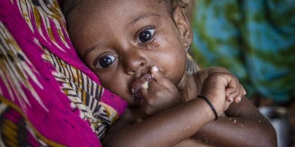 Malnutrizione Muna bambina yemen con mano in bocca