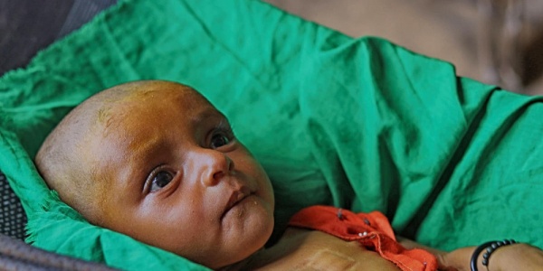 Yemen, dopo 3 anni via alla riapertura dell’aeroporto di Sanaa ai voli sanitari bambina con vestitino rosso sdraiata su lettino con lenzuola verdi